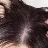 Dandruff Remedy,താരൻ മാറ്റിയെടുക്കാൻ കറ്റാർവാഴ മാസ്ക് - easy home ...