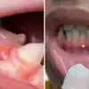 Home Remedies For Teeth Pus Serious Problem Called Gum Boil; दातातून पू ...