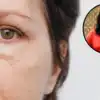 Under Eye Swelling Or Puffiness,आंखों के नीचे जमी पफीनेस को करें दूर ...