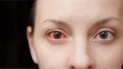 आंखों का लाल होना