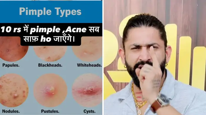 drink for pimples drink for pimples