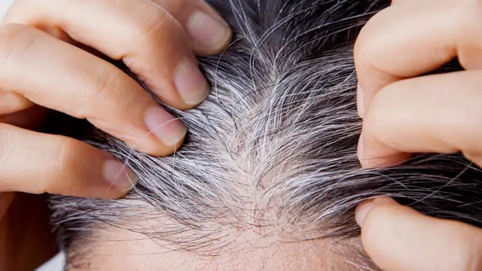 व्हाइट डिस्चार्ज और हेयरफॉल