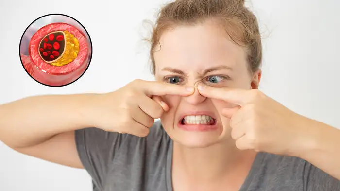 acne relation with other health diseases acne relation with other health diseases