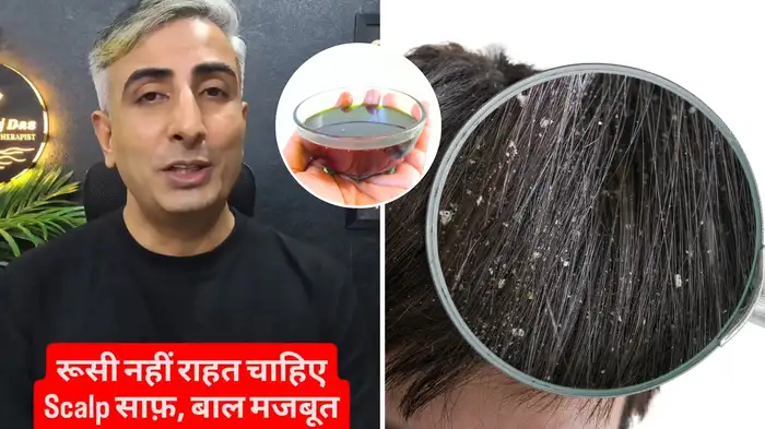 home remedies for dandruff home remedies for dandruff