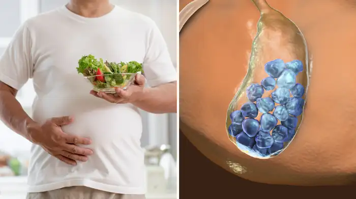 gall bladder stone gall bladder stone