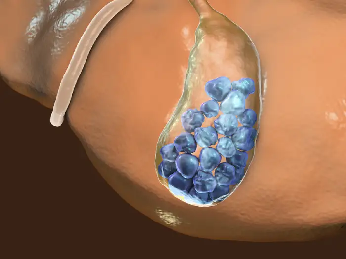 ज्यादा कोलेस्ट्रॉल और गॉल स्टोन