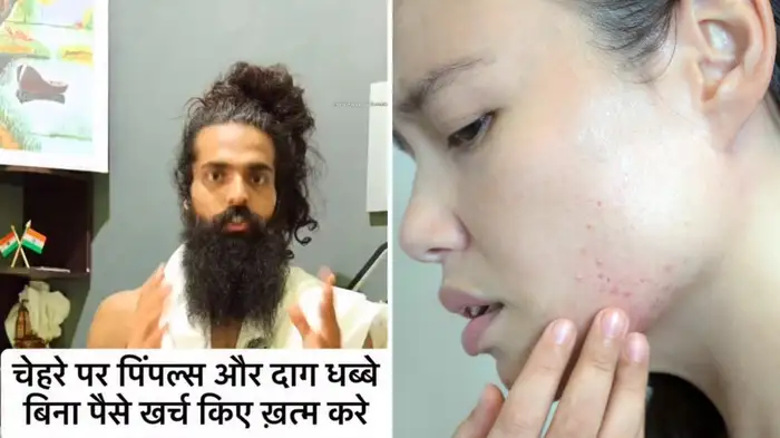 home remedy for pimples home remedy for pimples