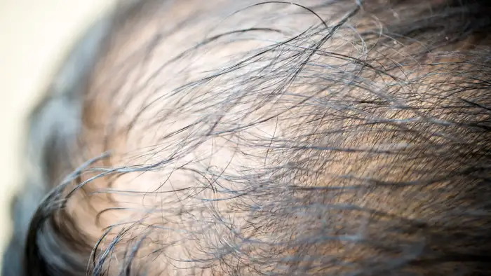 बालों का झड़ना कैसे रोकते हैं?