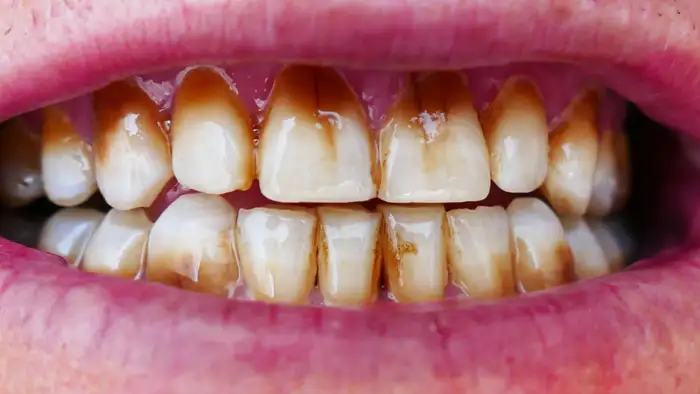 इनेमल घिसने के शुरुआती संकेत