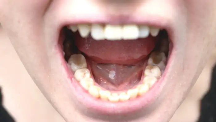 दांतों का कवच है इनेमल