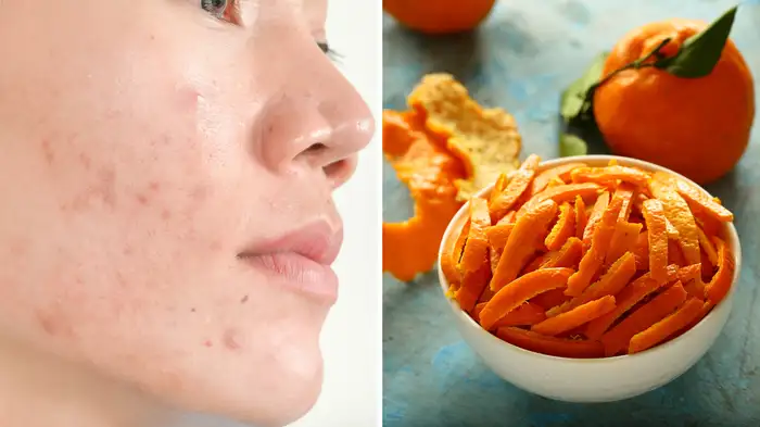 home remedy of orange peels home remedy of orange peels