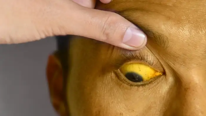 yellow eyes jaundice