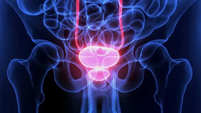 bladder cancer sign