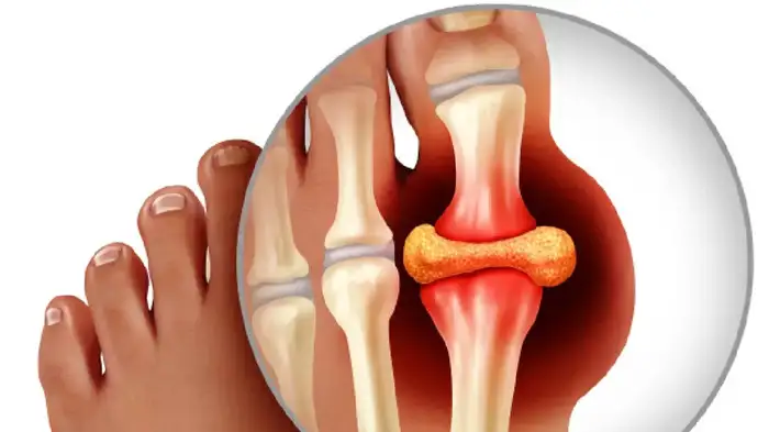 uric acid increasing foods uric acid increasing foods