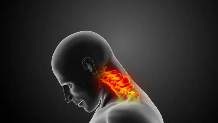 cervical spondylosis neck pain
