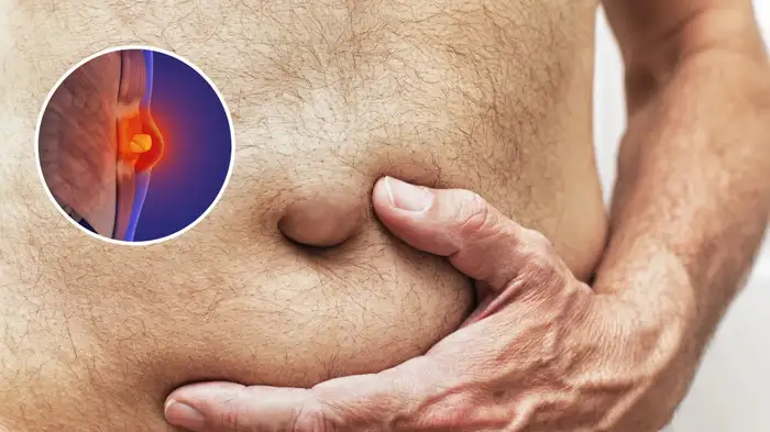 hernia recurrence causes hernia recurrence causes