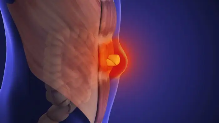 hernia 3d animation