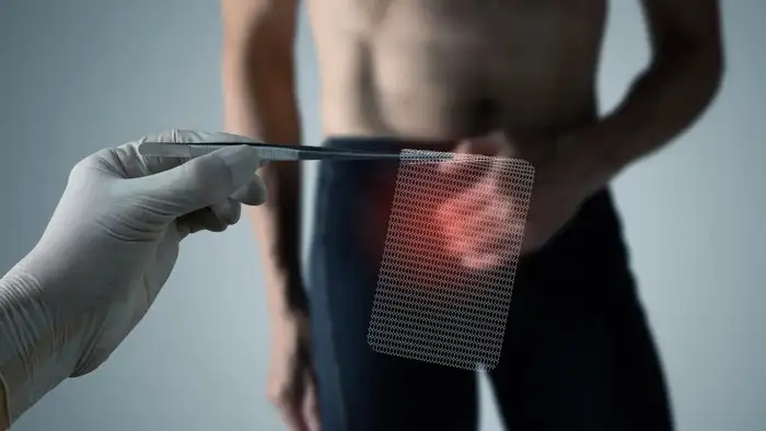 mesh for hernia operation