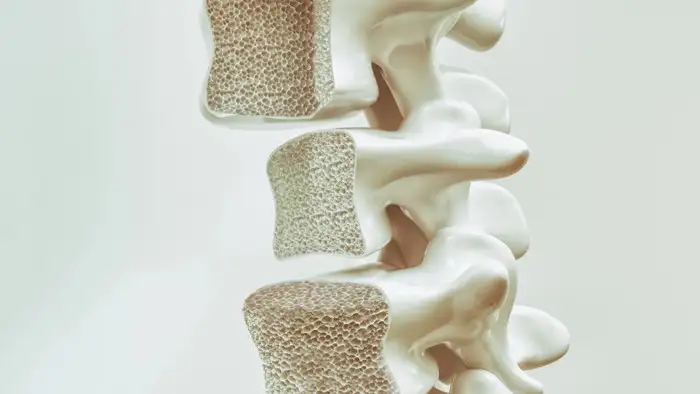 weak bones complication