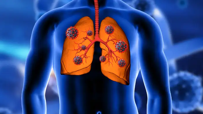 Dry cough can be sign of IPF <br>