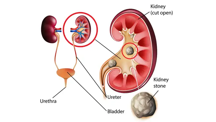 What size kidney stone can pass without surgery<br>