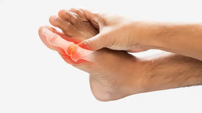 Can uric acid cause painful feet?<br>