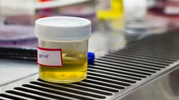 Urine test for bladder cancer<br>