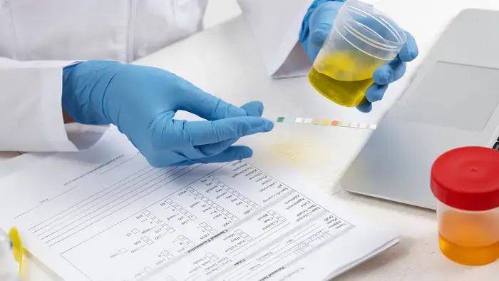 Urine test for bladder cancer<br><br>