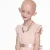 Shocking News When Teenager Died With Benjamin Button Disease In Uk