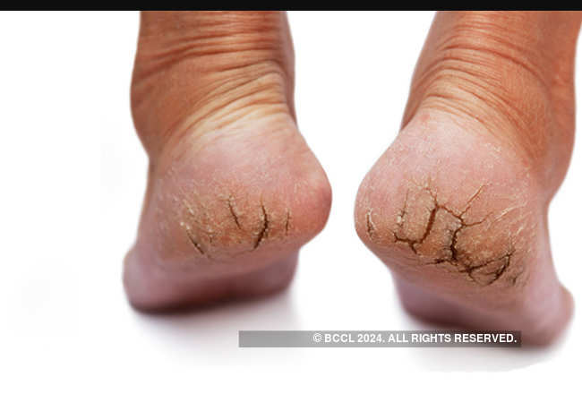 home remedies for cracked heels 61090527