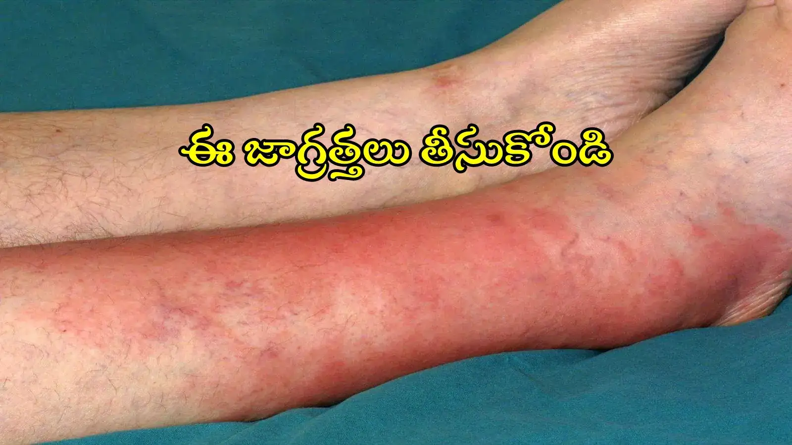 వణుకు పుట్టిస్తున్న సెల్యూలైటిస్ వ్యాధి.. కరీంనగర్ జిల్లాలోనే ఎక్కువ, లక్షణాలివే..