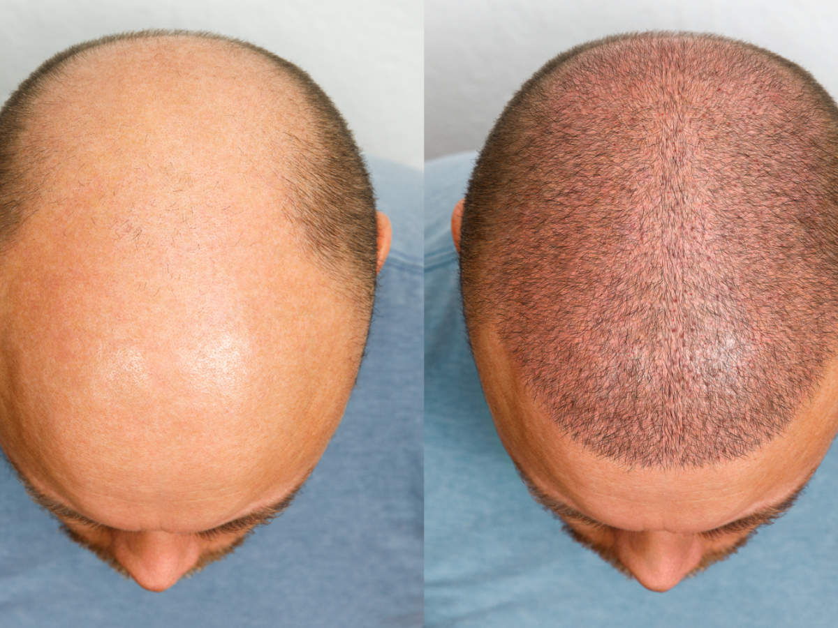 Things to keep in mind to grow hair even after hair transplant