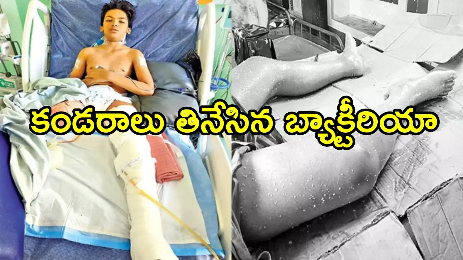 విజయవాడ: నీళ్లలో తిరిగి కాలు పోగొట్టుకున్న బాలుడు.. ఆ బ్యాక్టీరియా చాలా డేంజర్