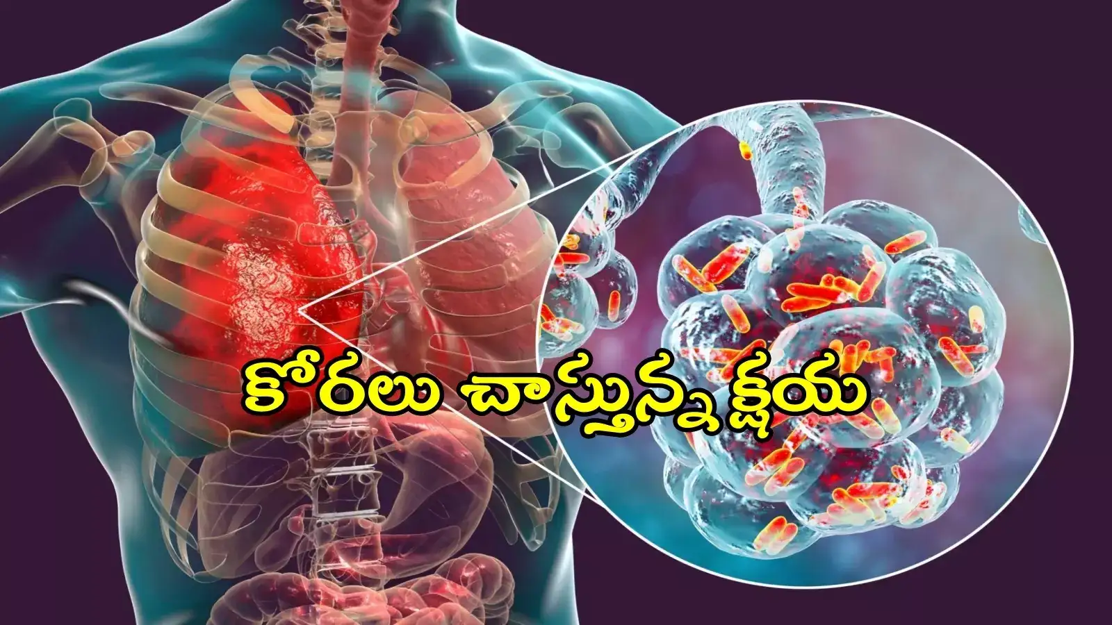 తెలంగాణలో కోరలు చాస్తున్న క్షయ.. కొత్తగా 4,600 టీబీ కేసులు, లక్షణాలివే