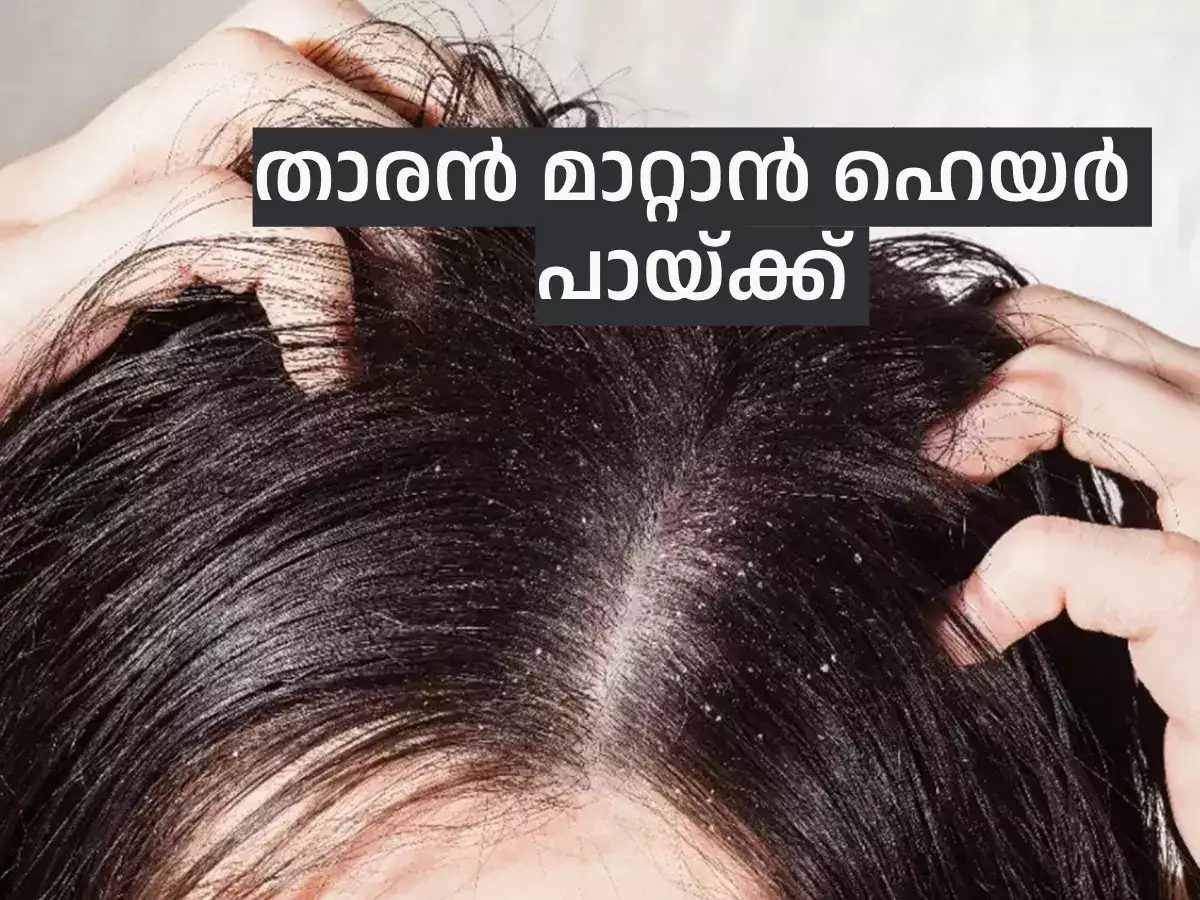 Discover more than 156 hair loss treatment malayalam POPPY