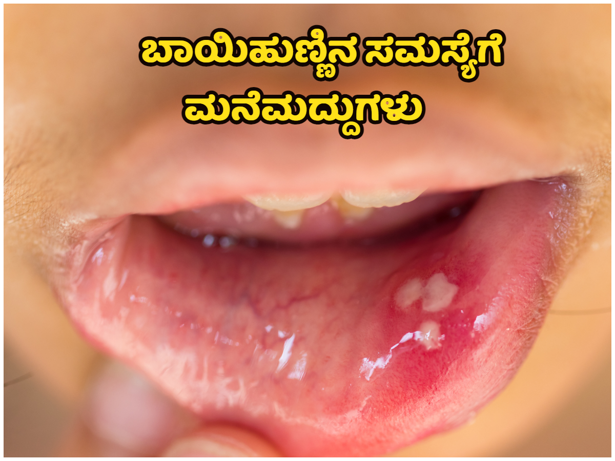 Here are some simple Ayurvedic home remedies for mouth ulcers