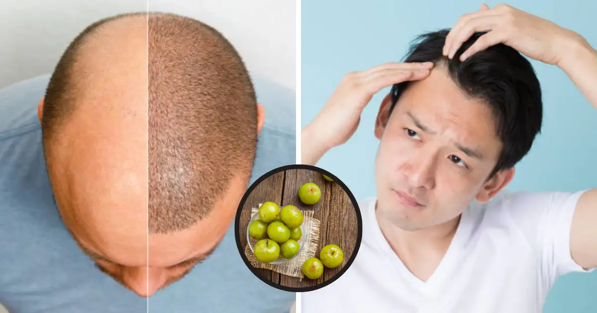 Ayurvedic Hair Fall Treatment; टक्कल पडण्याची भीती काढून टाका