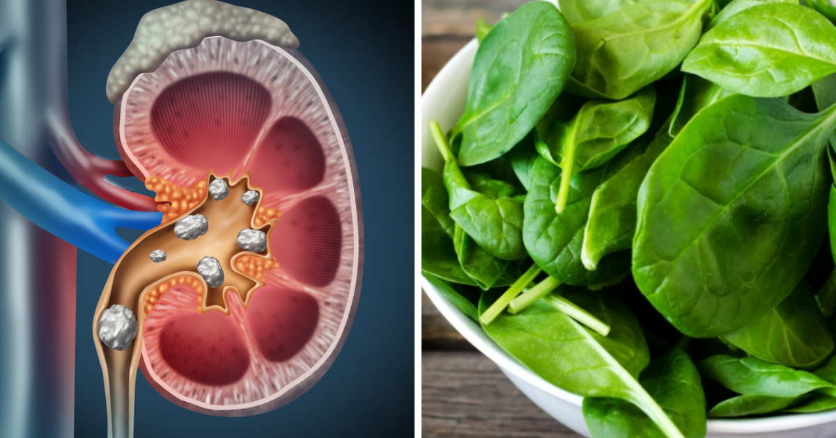 Foods To Eat And Avoid For Kidney Stones Kidney Stone Causing