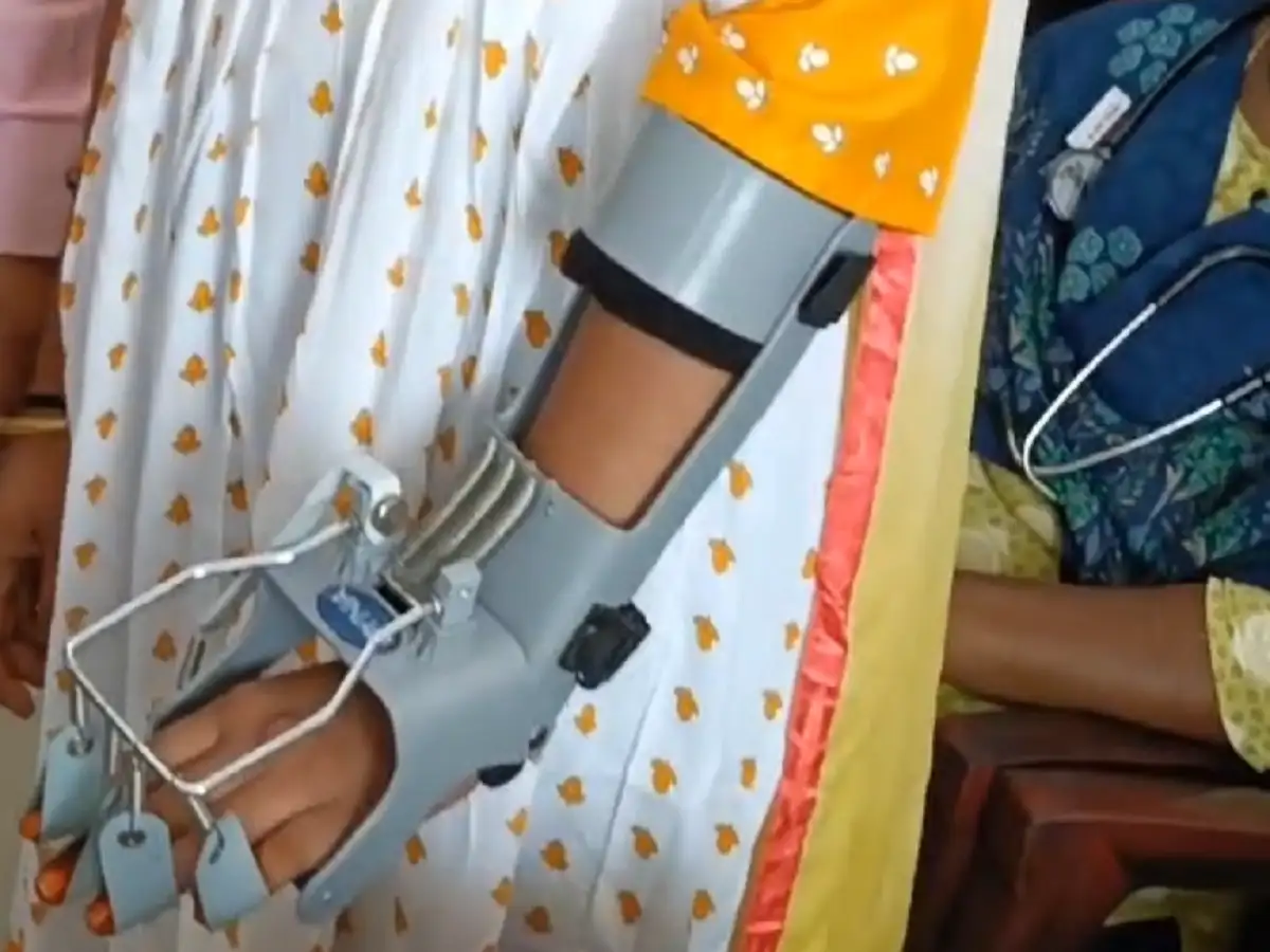 வெளிநாட்டு பெண்ணுக்கு எலும்பு முறிவு அறுவை சிகிச்சை; எடப்பாடி அரசு மருத்துவமனை ஆர்த்தோ மருத்துவர்கள் அசத்தல்! 