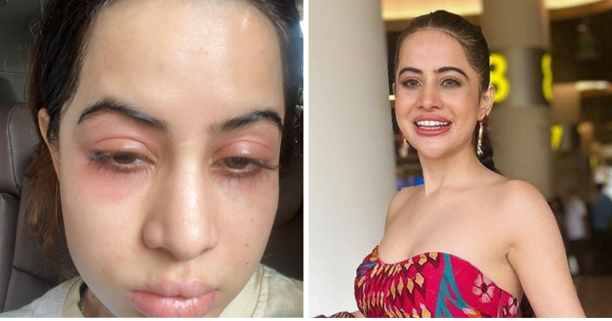 What happened to Urfi Javed's face? How did her blooming face get swollen? Run to the doctor as soon as you see the symptoms