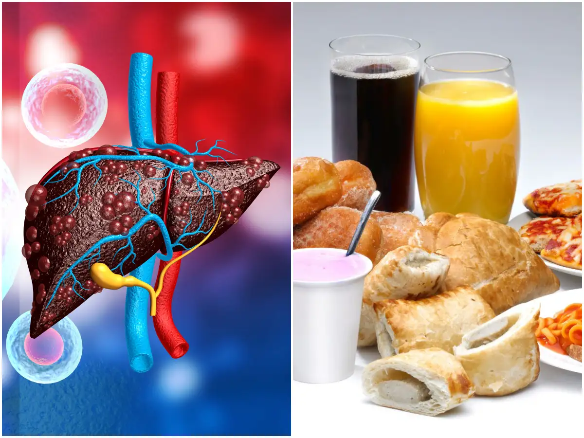 Worst Foods For Your Liver,Liver Diet:మందు తాగితేనే కాదు.. ఈ ఫుడ్స్‌ తిన్నా  లివర్‌కు మంచిది కాదు..! - these foods harm liver health - Samayam Telugu