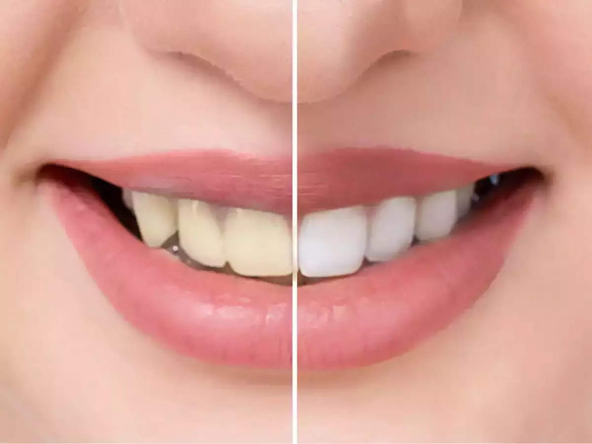 Milk and Arya Neem to remove stains and whiten teeth