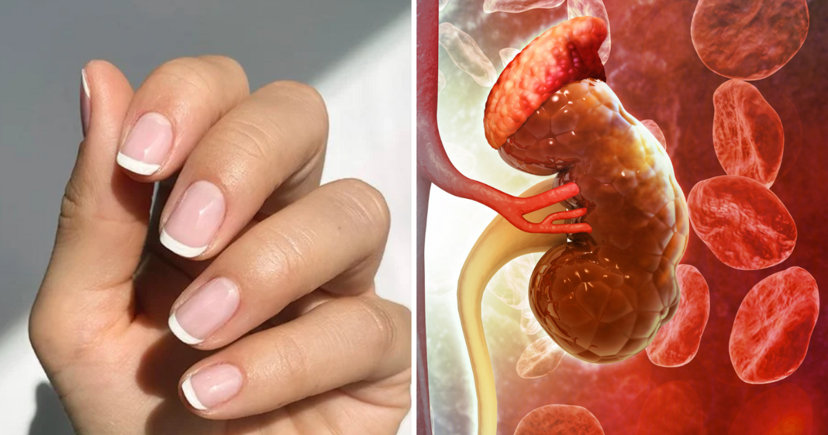 Find out if you have skin, eye or kidney cancer in 5 seconds by looking at your nails.