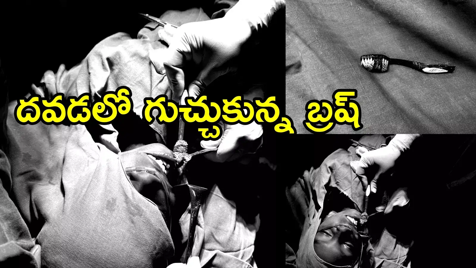కదిరి: పళ్లు తోముతుండగా బాలుడి దవడలో చొచ్చుకుపోయిన బ్రష్.. ఏమైందంటే