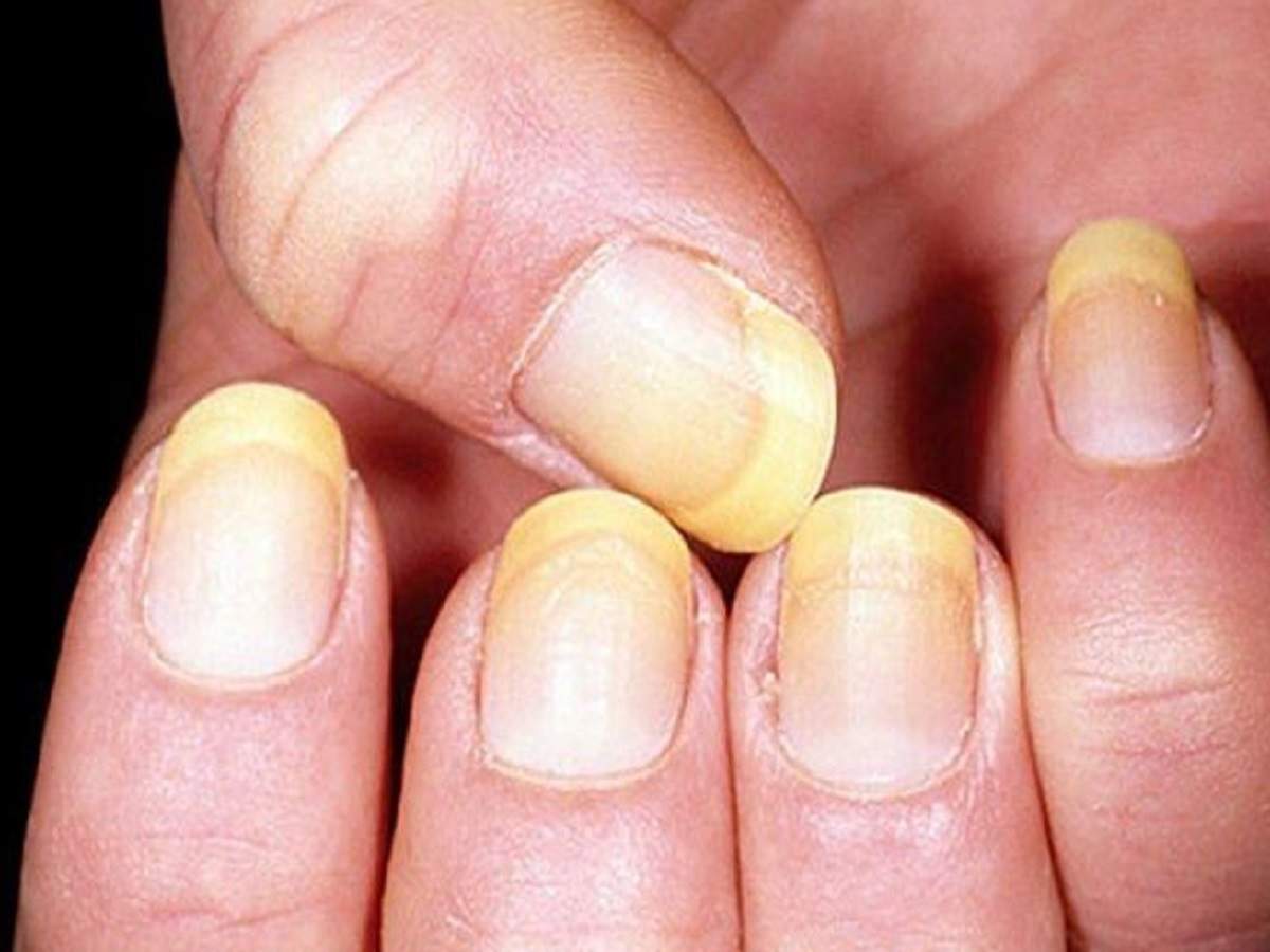 Why are your nails turning yellow and orange? - Quora