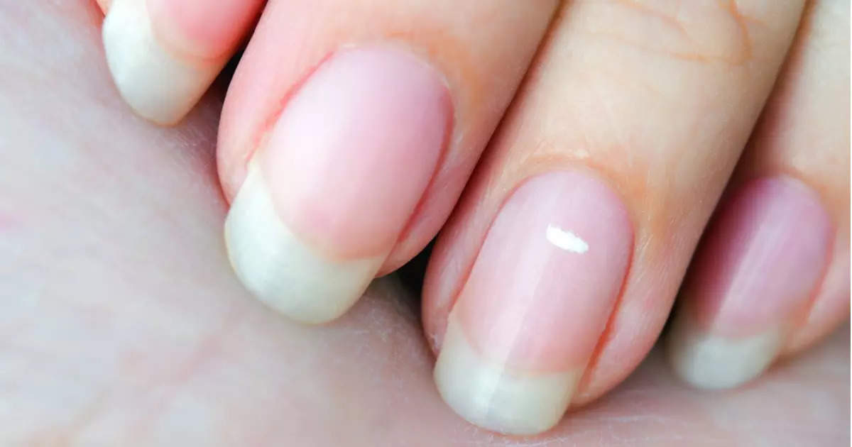 What white marks on nails mean about health - YouTube