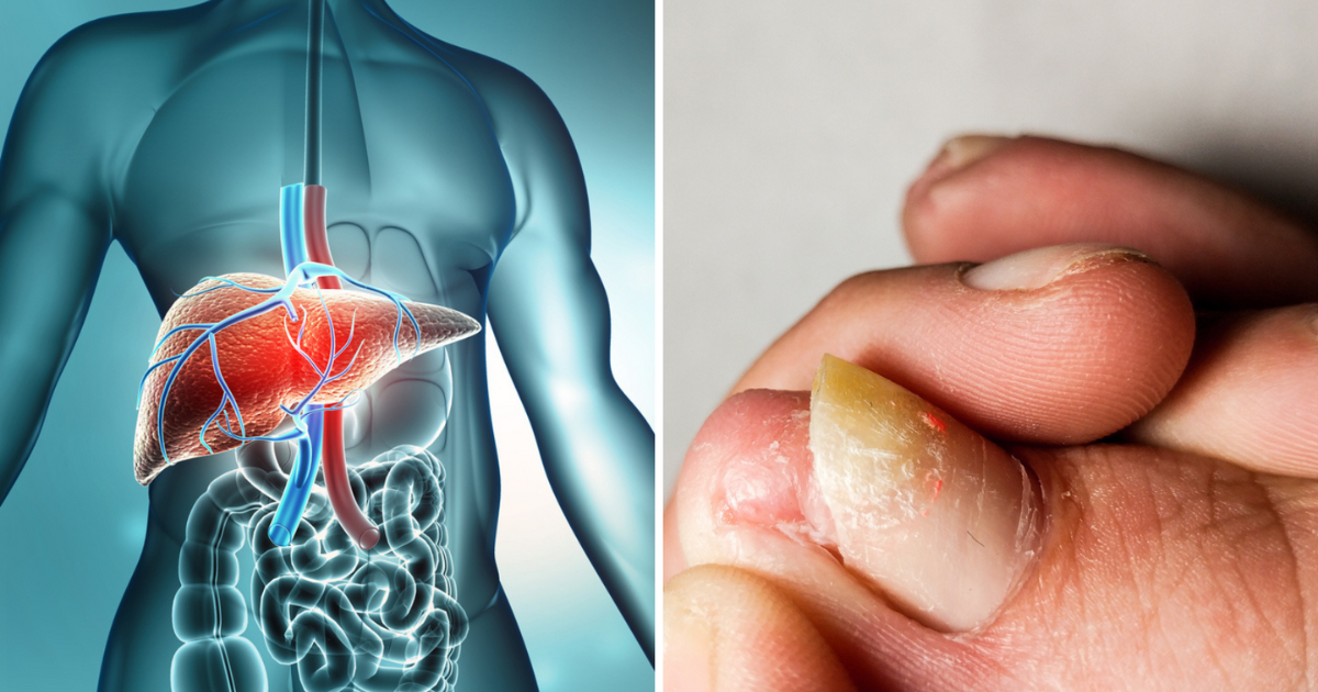How To Make Liver Strong,नाखून में दिख सकते हैं लिवर की खराबी के कुछ संकेत  - 6 severe symptoms of liver diseases you can see in your nails easily -  Navbharat Times