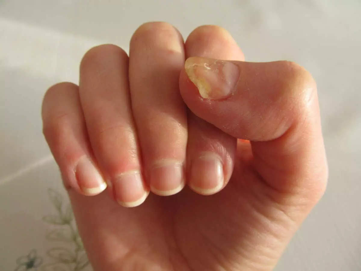 Toenail Falling Off? Here Are Its Causes, Management Tips And Recovery Time  | OnlyMyHealth