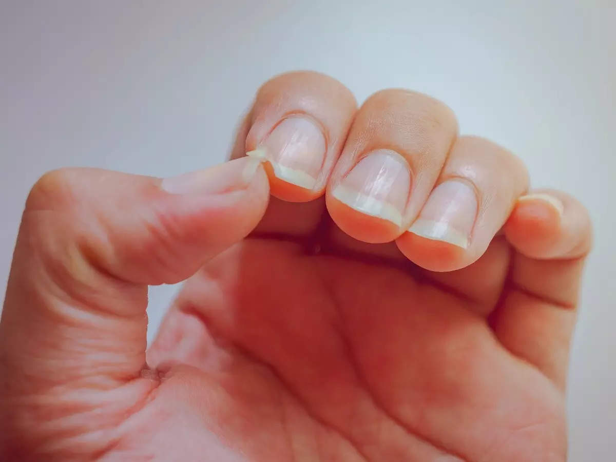 Nail Changes Associated With Thyroid Disease | MDedge Dermatology