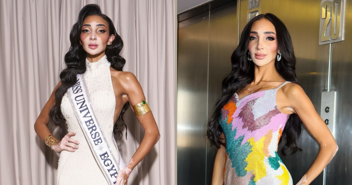 Egypt's Miss Universe Contestant Redefines Beauty Standards with Vitiligo-Inspired Style